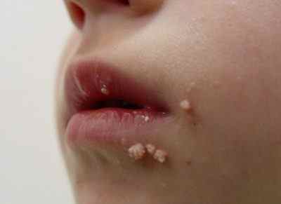 Чому зявляються папіломи на обличчі у дітей? Причини виникнення, симптоми і методи лікування