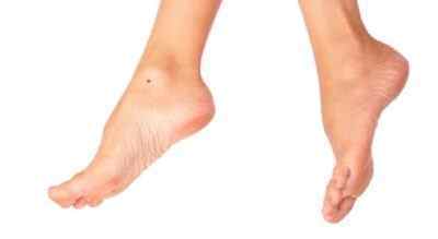 Чому зявляються родимки на нозі? Чи небезпечно це і яка методика їх лікування на мізинці, ступні або гомілки?