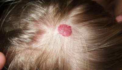 Чому зявляються родимки у дітей на голові під волоссям? Чи небезпечно для дитини, коли невус або родима пляма росте в розмірі?