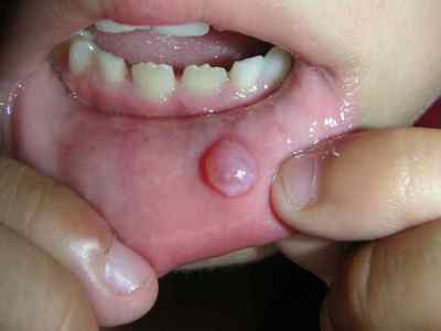 Чому зявляються і як лікують папіломи в горлі у дитини?