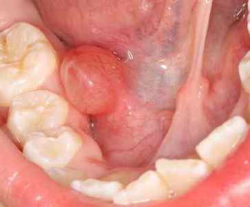 Чому зявляються і як лікують папіломи в горлі у дитини?