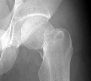 Чрезвертельний перелом бедеренной кістки: причини, симптоми, лікування