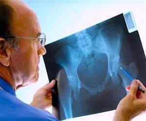 Чрезвертельний перелом стегна зі зміщенням реабілітація і лікування без операції і перелом стегна у літніх людей | Ревматолог