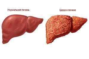 Цироз печінки - це рак? У чому їх схожість і відмінності, симптоми цирозу і раку печінки
