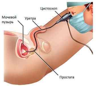 Цистоскопія сечового міхура у чоловіків: показання, підготовка і проведення