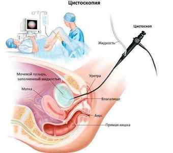 Цистоскопія сечового міхура: як роблять у жінок, чоловіків та дітей