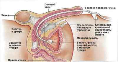 Цистостома сечового міхура у чоловіків: тривалість життя і наслідки