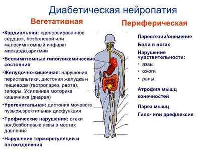 Діабетична нейропатія, її симптоми і лікування