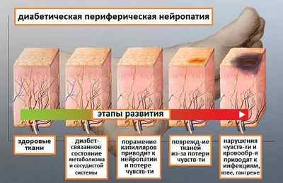 Діабетична нейропатія, її симптоми і лікування