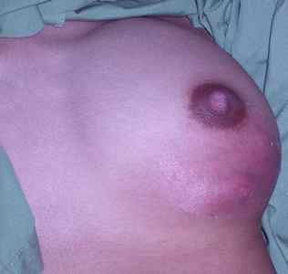 Діагностика, лікування та профілактика фурункулів на грудях і сосках. Фото чіріев на грудній залозі