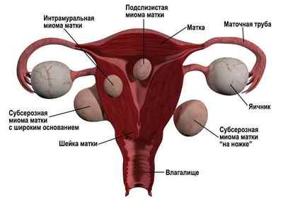 Діагностика міоми матки: способи визначення пухлини