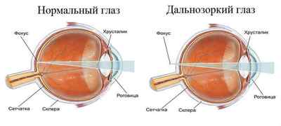 Далекозорість (гіперметропія): що це таке, як відновити зір при слабкому ступені