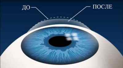 Далекозорість (гіперметропія): що це таке, як відновити зір при слабкому ступені