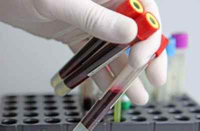 Де здати аналіз крові на ВПЛ в Росії: мережа лабораторій «Інвітро»