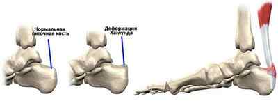 Деформація Хаглунд: лікування наросту Хаглунд народними засобами, деформація пяткової кістки, операція | Ревматолог