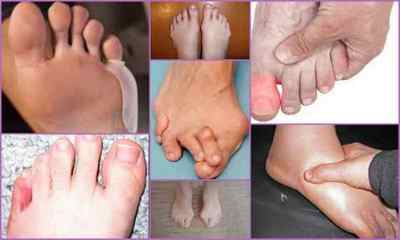 Деформація пальців ніг - види, симптоми, лікування