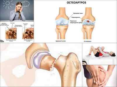 Деформуючий артрит: лікування колінного суглоба