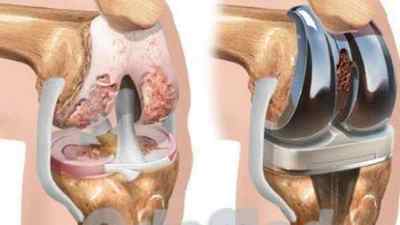 Деформуючий артроз колінного суглоба 1 2 і 3 ступеня: симптоми і лікування, що це таке, ознаки дефартроза суглоба | Ревматолог