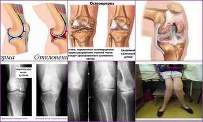 Деформуючий артроз колінного суглоба 12 3 ступеня: лікування, симптоми і ознаки
