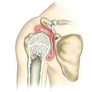 Деформуючий остеоартроз (ДОА) плечового суглоба 1 і 2 ступеня: симптоми і лікування народними засобами | Ревматолог
