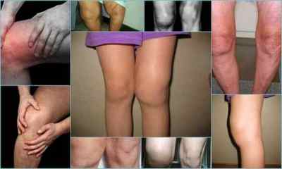 Деформуючий остеоартроз колінного суглоба 123 ступеня - лікування і ознаки