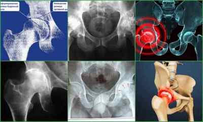 Деформуючий остеоартроз кульшового суглоба 123 ступеня - симптоми і лікування