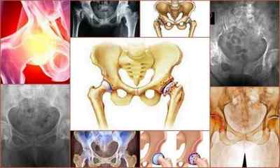 Деформуючий остеоартроз кульшового суглоба 123 ступеня - симптоми і лікування