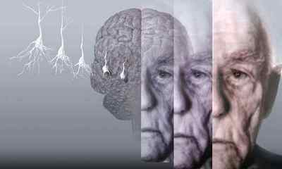 Деменція, стадії розвитку, прогноз тривалості життя