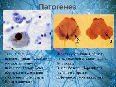 Деменція з тільцями Леві скронево-лобова, причини і симптоми