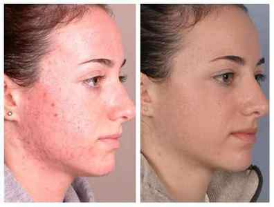 Демодекс: лікування шкіри обличчя, фото кліща