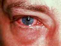 Дерматит повік: лікування навколо очей, контактні лінзи при себорейної патології