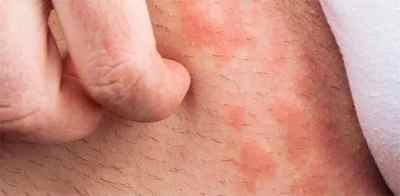 Дерматомікоз шкіри: що це таке, лікування і симптоми