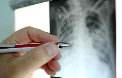 Диференціальна діагностика ХОЗЛ і бронхіальної астми