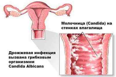 Дифлюкан: інструкція із застосування при молочниці у жінок