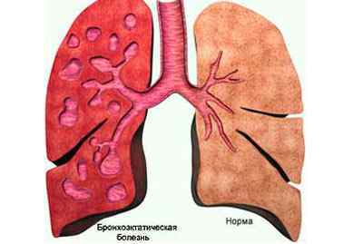 Дифузний пневмосклероз легенів: що це таке і як його лікувати