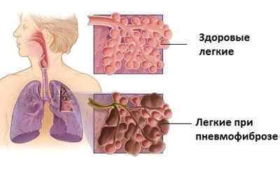 Дифузний пневмосклероз легенів: що це таке і як його лікувати