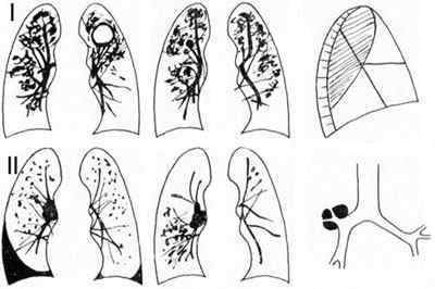 Дисемінований туберкульоз легень: що це таке, заразний чи він