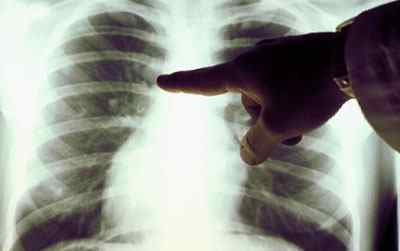 Дисемінований туберкульоз легень: що це таке, заразний чи він