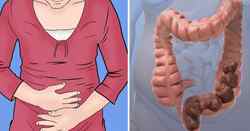 Дискінезія кишечника: види, симптоми і лікування