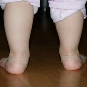 Дисплазія колінних суглобів: що це таке, симптоми і лікування у дітей та дорослих, вроджена дисплазія, причини, код за МКХ 10 | Ревматолог