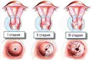 Дисплазія шийки матки 3 ступеня: симптоми, лікування і прогноз