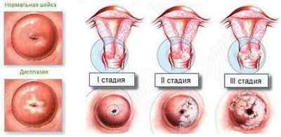Дисплазія шийки матки і вагітність: яка сумісність