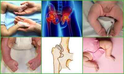 Дисплазія тазостегнових суглобів у дітей: фото, симптоми, лікування