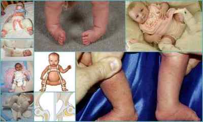 Дисплазія тазостегнових суглобів у дітей: фото, симптоми, лікування