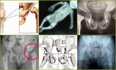 Дисплазія тазостегнових суглобів у грудничка: ознаки, фото, лікування
