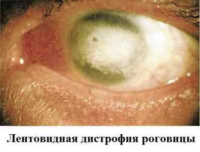 Дистрофія рогівки ока: що це таке, лікування, види дегенерації (ендотеліальна, стрічкоподібна)