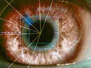 Дистрофія сітківки ока: що це таке, лікування народними засобами, симптоми атрофії