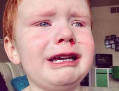 Дитина вдарилася носом: що робити, якщо пішла кров, ніс розпух