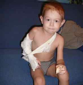 Дитина зламав руку - перша допомога та лікування