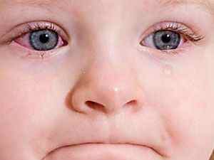 Дитячий конюнктивіт: симптоми і лікування у дітей, причини, як виявляється, профілактика